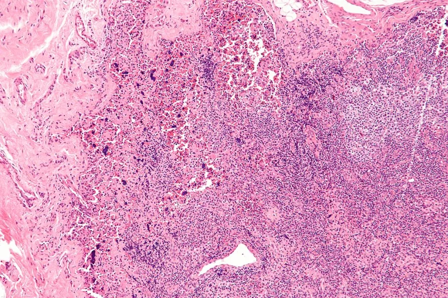 Northwestern Scientists Find the ‘Off Switch’ for Lupus Hidden in Human DNA