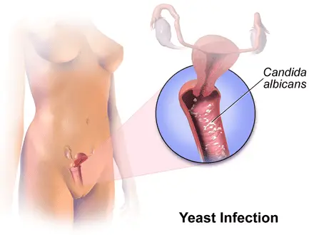The Microscopic Vampire That Could Cure Candida Infections
