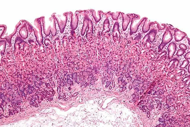 Why Some People Never Get Sick—The Genetic Lottery That Creates Super Immune Systems