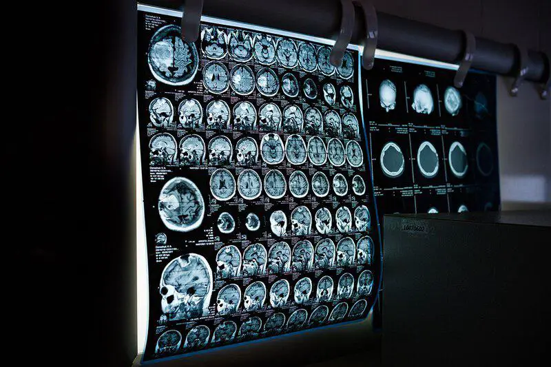 Top 15 Weirdest Things Scientists Have Ever Found Inside the Human Body