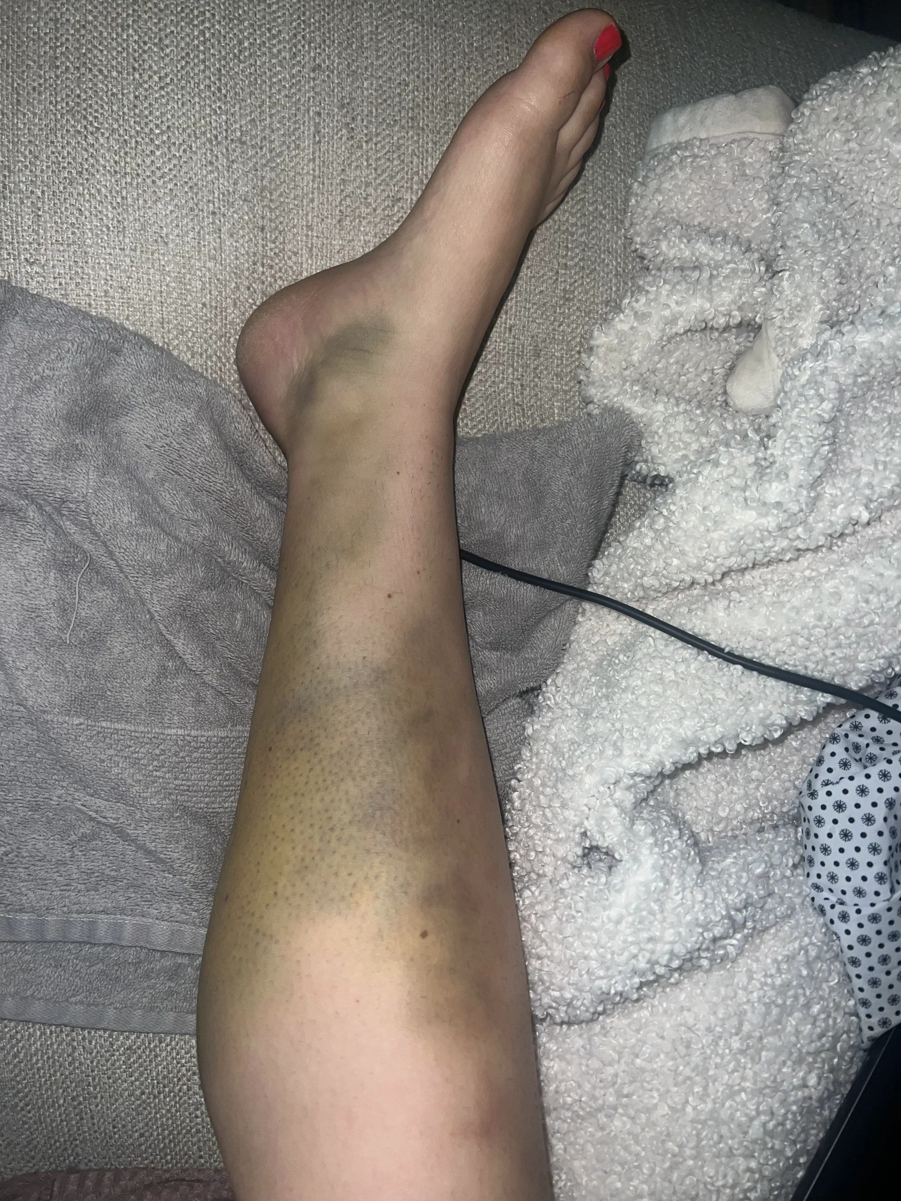 19 Monstrous Marvels That Challenge Your Perception of Size! 🦙🔍 35 Absolute Units of a bruise … it got worse!