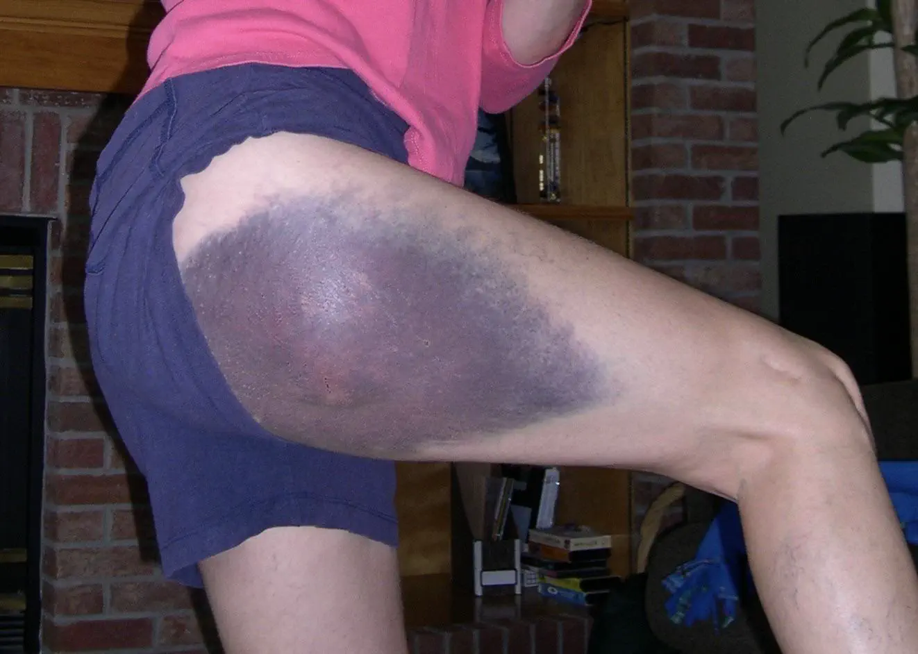 19 Monstrous Marvels That Challenge Your Perception of Size! 🦙🔍 36 Absolute Units of a rollerblading bruise