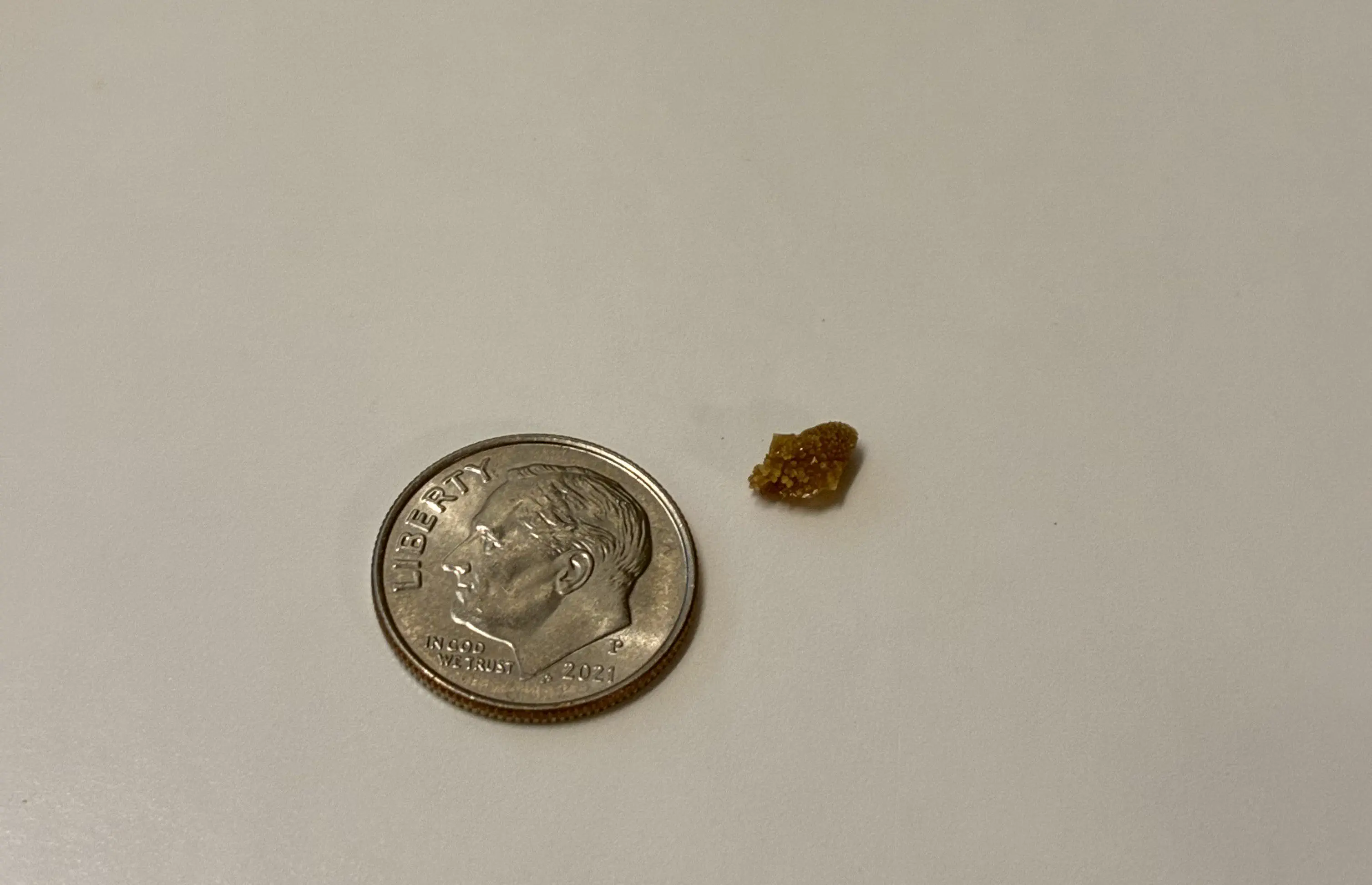 12 Insanely Large Oddities That Will Leave You Amazed! đ€ŻđŸ 22 Absolute Units of a kidney stone I just passed