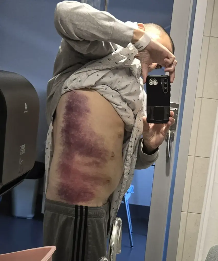 12 Amazing Absolute Units That Redefine Perceptions! đŸ 13 absolute units of a bruise