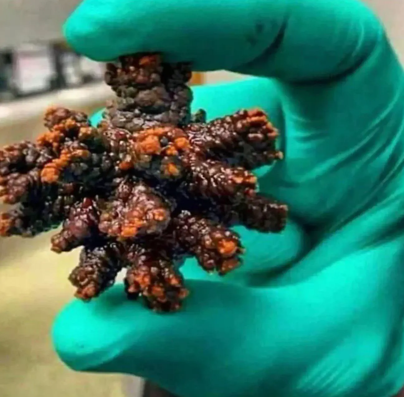 10 Breathtaking Oddities Exceeding Your Size Expectations! đ€Żđ 22 Absolute Units of a kidney stone