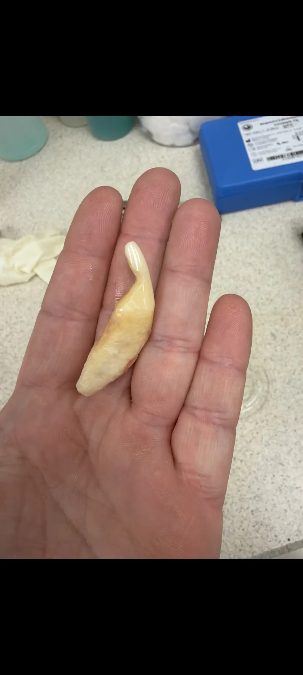 14 Absolute Units That Broke Every Known Scale 🫣 27 Massive canine tooth and root that is an absolute unit