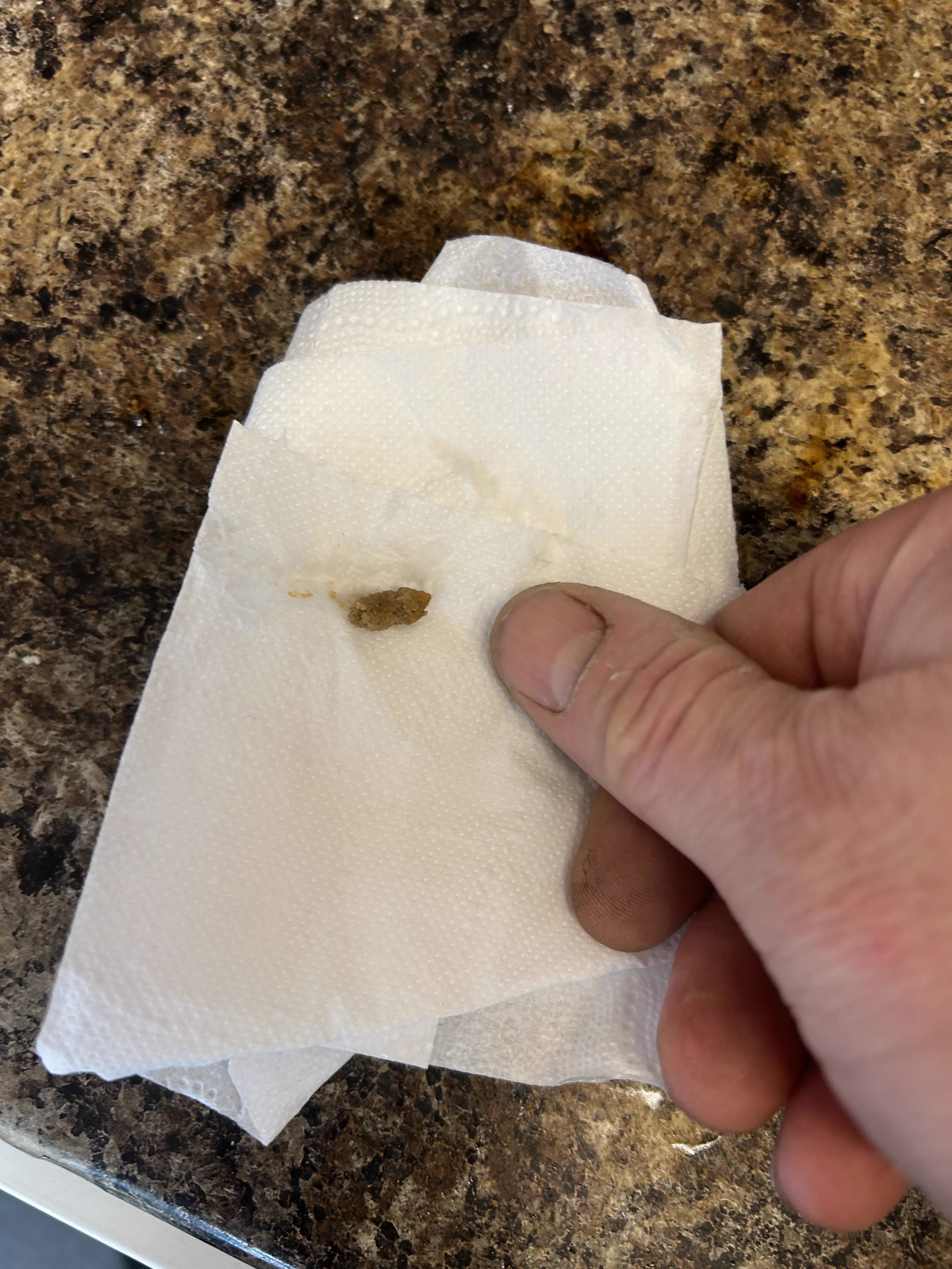 We Found 8 Things That Have No Business Being This Big đ« 14 Massive kidney stone that is terrifyingly large