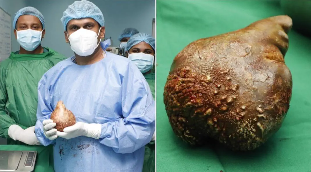 POV: You vs These 11 Absolute Tanks of the Internet 20 Absolute Units of a world's largest kidney stone