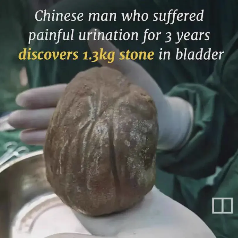 We Found 10 Oversized Wonders That Defy All Logic 🤯 34 Absolute Units of a bladder stone