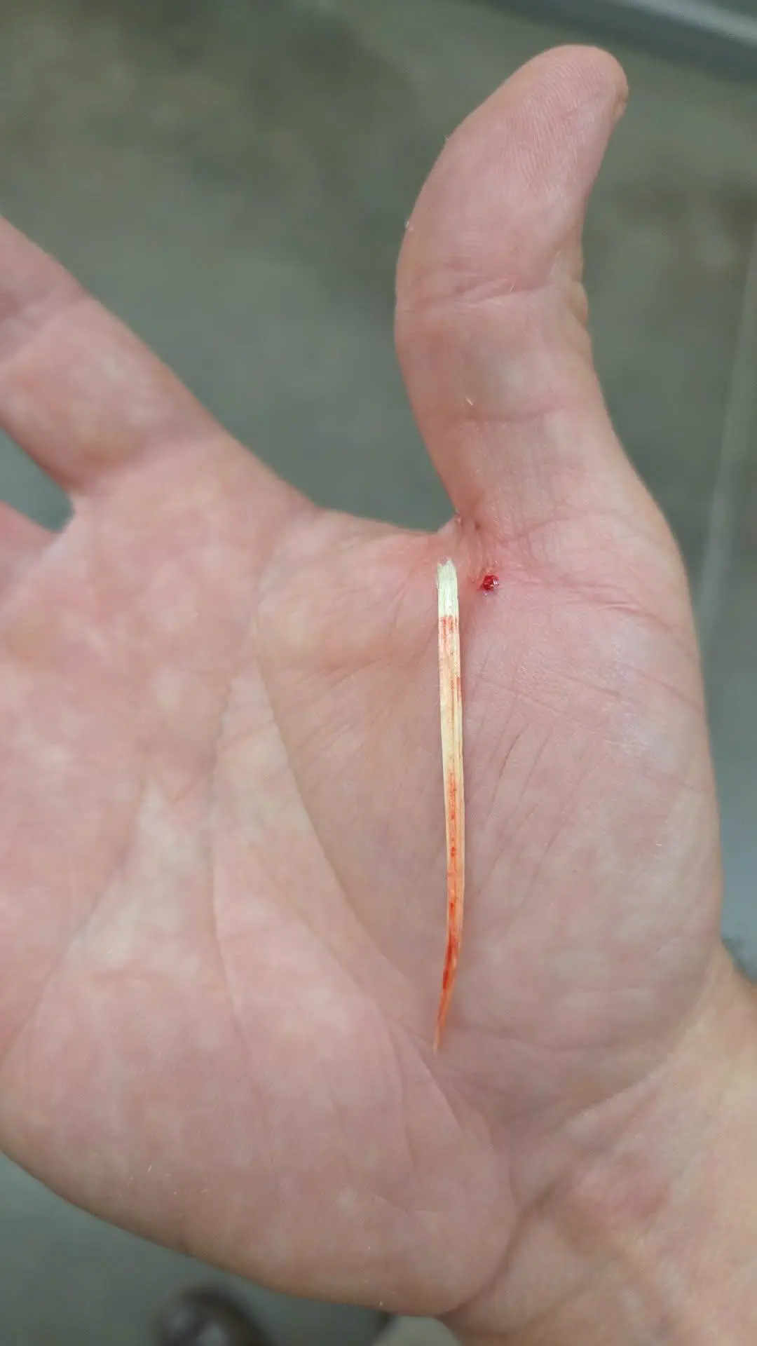 These 8 Everyday Objects Turned Into Absolute Units Overnight đ« 10 Absolute unit of a splinter pulled from a hand